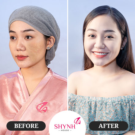 Dịch vụ new perfect Skin Nám  - Shynh House