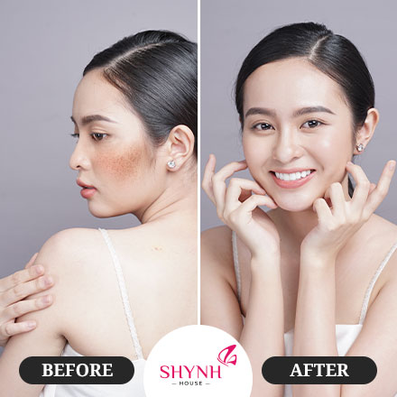 Khách hàng sử dụng dịch vụ new perfect Skin Nám  - Shynh House