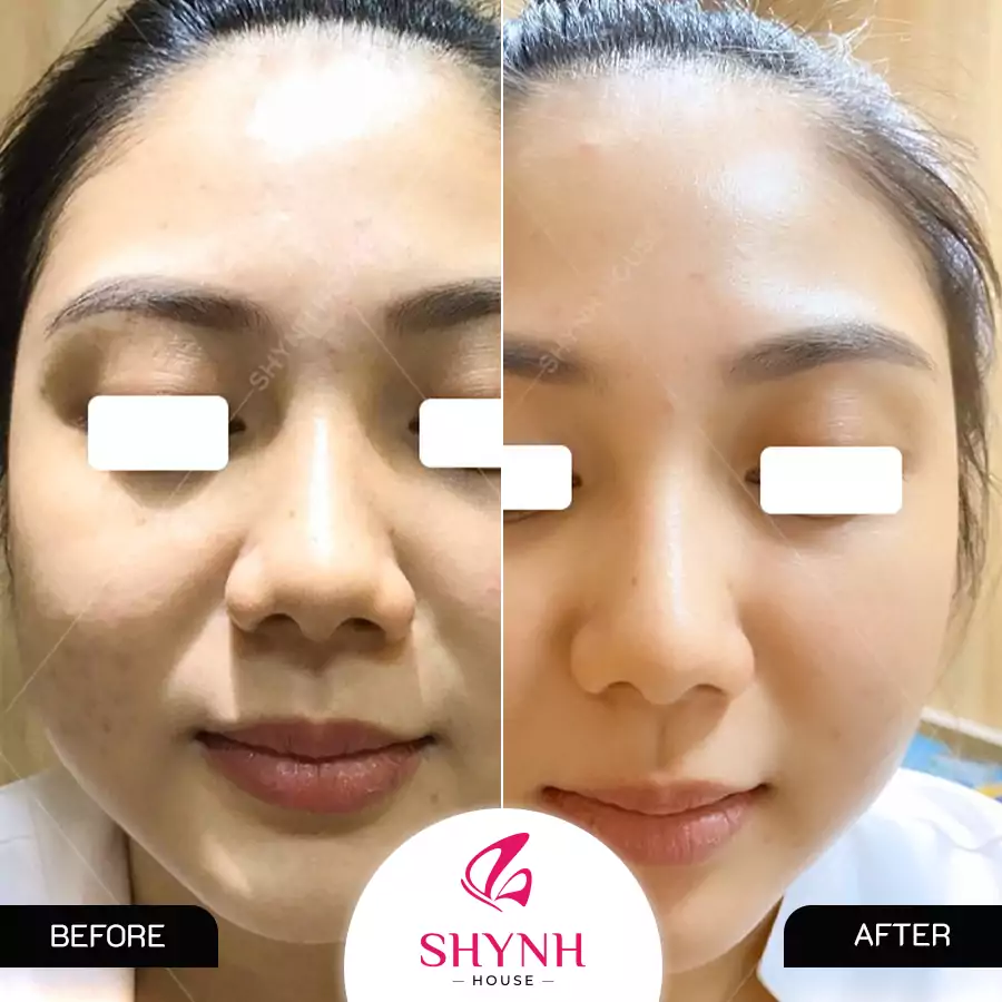 Khách hàng Nâng cơ Trẻ hóa da công nghệ Hifu