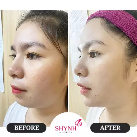 Khách hàng sau khi thực hiện Instafill cấy HA protein