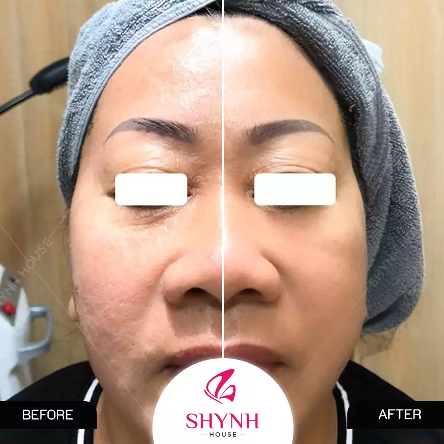 Trước và sau khi sử dụng công nghệ Hifu
