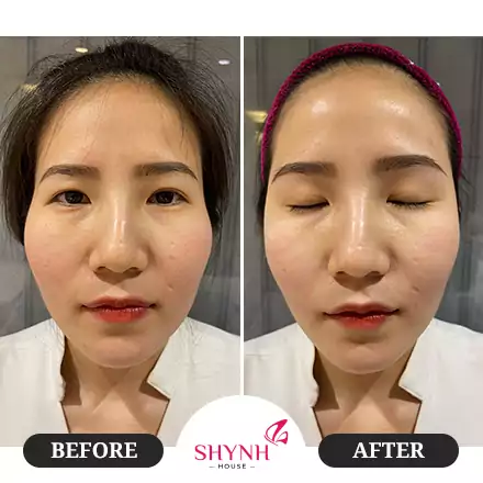 Trước và sau khi thực hiện Instafill cấy HA protein
