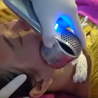 Tiến hành bóc tách sẹo rỗ