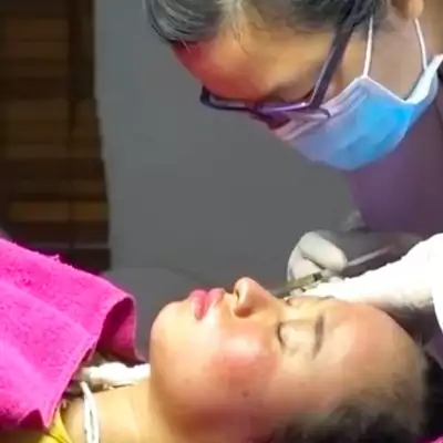 Tiêm PRP vào da mặt