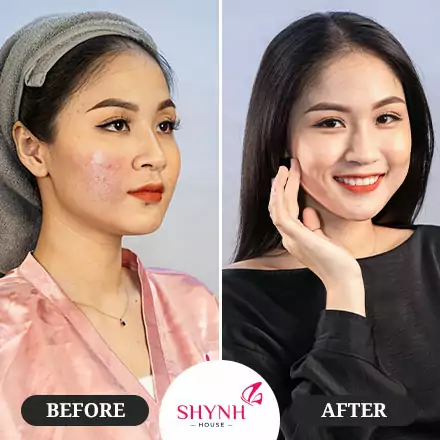 Hình trước sau cấy trứng cá tuyết