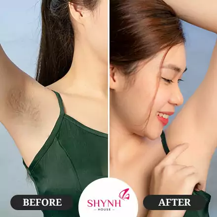hình trước sau triệt lông