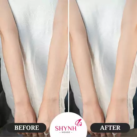 hình trước sau triệt lông