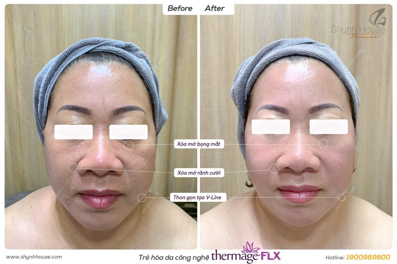 Sự thay đổi khác biệt rõ rệt chỉ sau 1 lần thực hiện 60 phút Thermage FLX trên khuôn mặt, làn da của khách hàng.