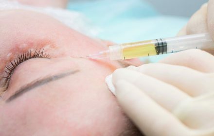 PRP – trích ly huyết tương giàu tiểu cầu phép màu cho làn da PRP – trích ly huyết tương giàu tiểu cầu phép màu cho làn da