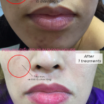 PEELING ĐIỀU TRỊ MỤN SINH HỌC – Shynh House Spa & Cosmetics