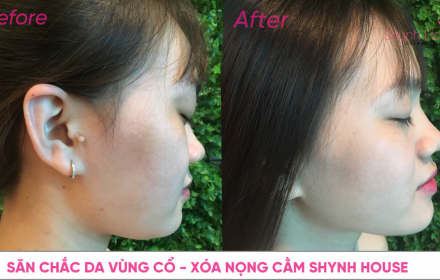 Săn chắc da vùng cổ – xóa nọng cằm Shynh House Săn chắc da vùng cổ – xóa nọng cằm Shynh House