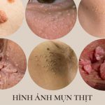 Mụn thịt là gì?