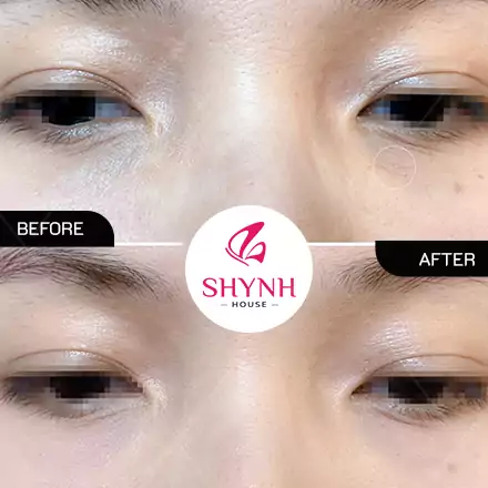 Khách hàng sau khi Cấy meso trị quầng thâm mắt