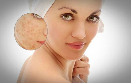Top 10 thuốc trị sẹo rỗ hiệu quả nhất hiện nay Top 10 thuốc trị sẹo rỗ hiệu quả nhất hiện nay