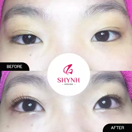 Trước và sau khi sử dụng phủ mi collagen