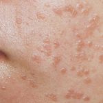 Vì sao mụn cơm hình thành