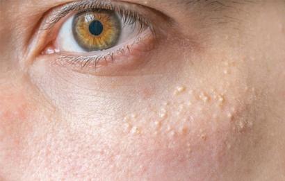Cách trị mụn cơm an toàn hiệu quả tận gốc Cách trị mụn cơm an toàn hiệu quả tận gốc