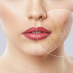 cách trị mụn đầu đen tại nhà