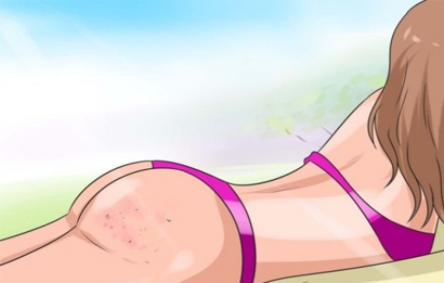 Nguyên nhân và cách trị mụn nhọt ở mông tận gốc tại nhà Nguyên nhân và cách trị mụn nhọt ở mông tận gốc tại nhà