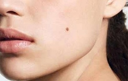 Mụn ruồi là gì và các cách trị mụn ruồi hiệu quả và an toàn Mụn ruồi là gì và các cách trị mụn ruồi hiệu quả và an toàn