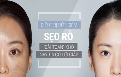 Cách trị sẹo rỗ nhanh chóng, hiệu quả nhất hiện nay Cách trị sẹo rỗ nhanh chóng, hiệu quả nhất hiện nay