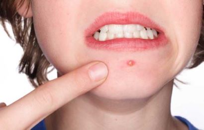 Tiết lộ cách trị mụn mủ an toàn tại nhà mới nhất Tiết lộ cách trị mụn mủ an toàn tại nhà mới nhất