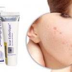 Điều trị sẹo rỗ bằng kem trị sẹo Scar Esthetique