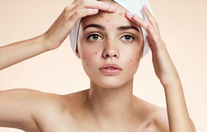 Top 15 cách trị thâm mụn tại nhà an toàn và hiệu quả nhất Top 15 cách trị thâm mụn tại nhà an toàn và hiệu quả nhất