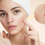 Có nhiều nguyên nhân gây ra thâm mụn