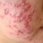 Mụn viêm đỏ không nhân và những điều bạn cần biết