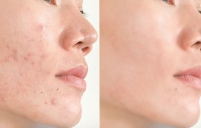 Bật mí cách chăm sóc da mụn hàng ngày hiệu quả nhất Bật mí cách chăm sóc da mụn hàng ngày hiệu quả nhất