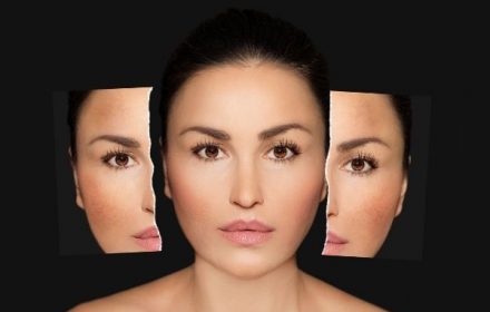 4 điều cốt lõi để có cách chăm sóc da mặt bị nám thực sự hiệu quả 4 điều cốt lõi để có cách chăm sóc da mặt bị nám thực sự hiệu quả