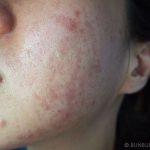 Mùa đông da thường có biểu hiện ửng đỏ