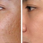 Hiệu quả của tế bào gốc trong thẩm mỹ trước hết là điều trị sẹo rỗ