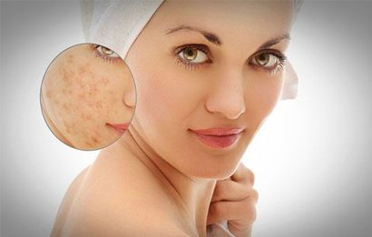 Hiểu rõ về các loại tế bào gốc trị sẹo rỗ Hiểu rõ về các loại tế bào gốc trị sẹo rỗ
