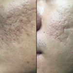 Chúng ta thường bị sẹo rỗ phổ biến hơn sẹo lồi.