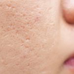 Sẹo rỗ lâu năm