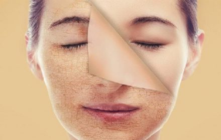 DA BỊ XỈN MÀU: NGUYÊN NHÂN VÀ CÁCH KHẮC PHỤC DA BỊ XỈN MÀU: NGUYÊN NHÂN VÀ CÁCH KHẮC PHỤC