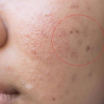 thâm mụn xấu xí