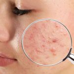 Mụn nội tiết gây mất thẩm mỹ gương mặt