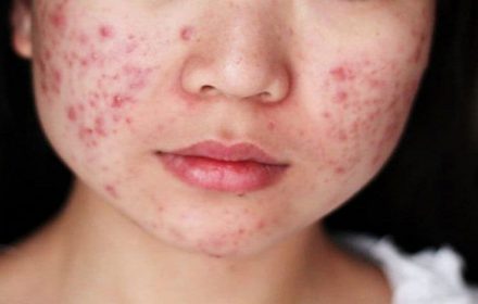 Cẩm nang tất tần tật về mụn viêm và giải pháp điều trị dứt điểm Cẩm nang tất tần tật về mụn viêm và giải pháp điều trị dứt điểm