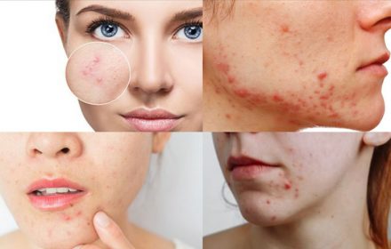 Tổng hợp các toa thuốc trị mụn hiệu quả nhất theo bác sĩ chuyên khoa Tổng hợp các toa thuốc trị mụn hiệu quả nhất theo bác sĩ chuyên khoa
