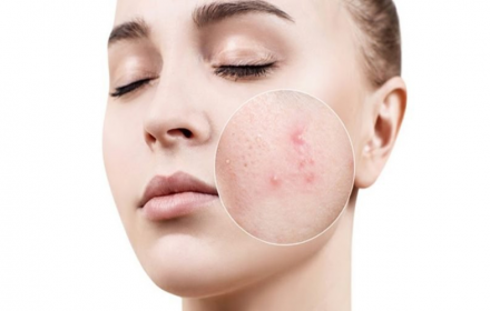 HƯỚNG DẪN CÁCH CHĂM SÓC DA MỤN ĐÚNG CÁCH HƯỚNG DẪN CÁCH CHĂM SÓC DA MỤN ĐÚNG CÁCH