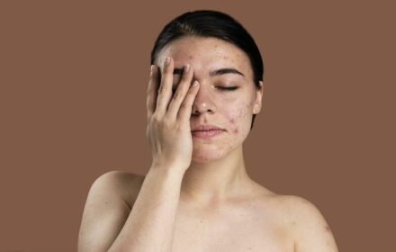 CORTICOSTEROID BÔI: TÁC DỤNG VÀ HƯỚNG DẪN DÙNG CORTICOSTEROID BÔI: TÁC DỤNG VÀ HƯỚNG DẪN DÙNG