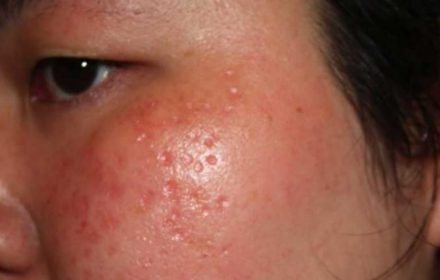 Tìm hiểu về công nghệ bắn laser trị nám tiên tiến Tìm hiểu về công nghệ bắn laser trị nám tiên tiến
