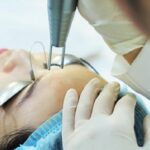 công nghệ Laser YAG