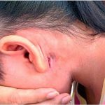 vi khuẩn ăn thịt người