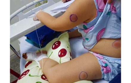 Phát hiện bệnh nhiễm vi khuẩn ăn thịt người và cách phòng tránh tốt nhất Phát hiện bệnh nhiễm vi khuẩn ăn thịt người và cách phòng tránh tốt nhất