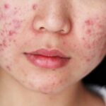 Mụn ở mặt