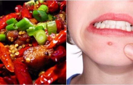 Bị mụn không nên ăn gì? Ăn gì tốt nhất Bị mụn không nên ăn gì? Ăn gì tốt nhất